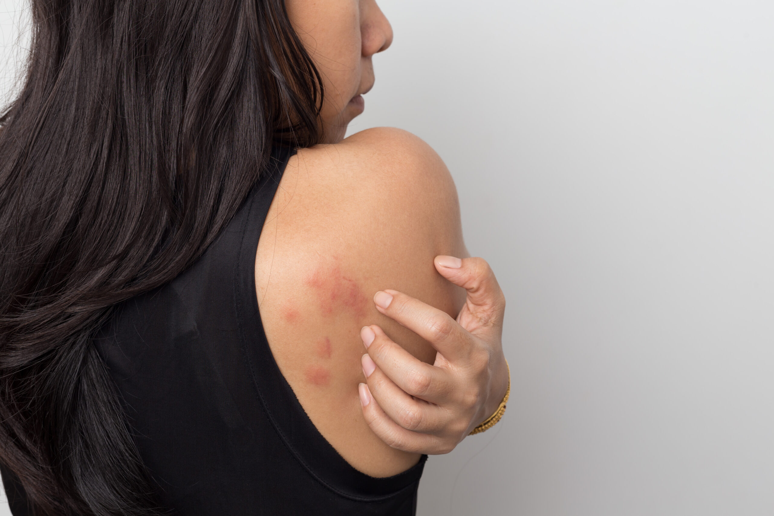 woman showing her skin itching behind , with allergy rash