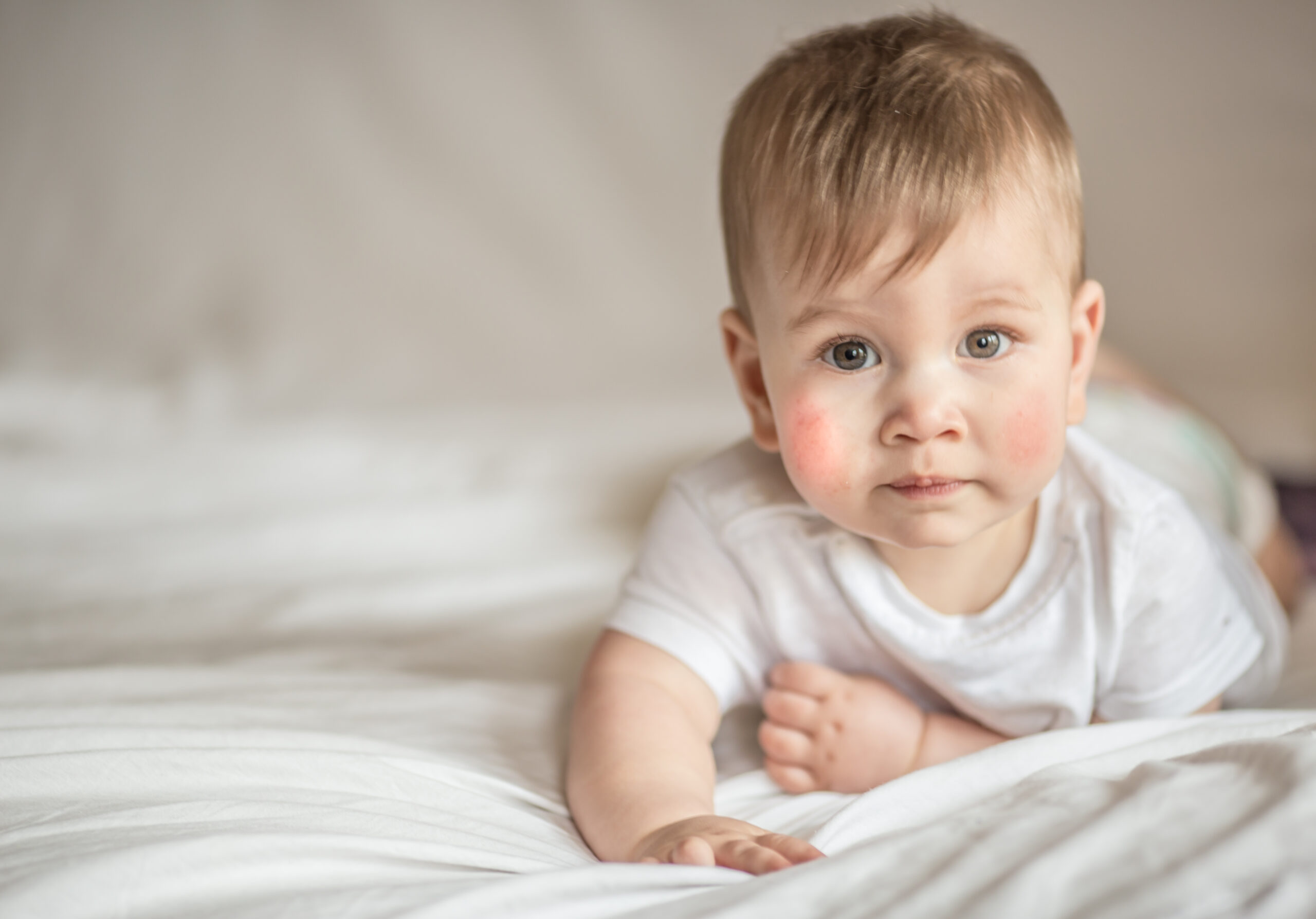 Atopic dermatitis eczema in baby