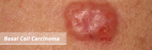 basal cell carcinoma