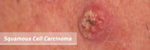 Squamous Carcinoma