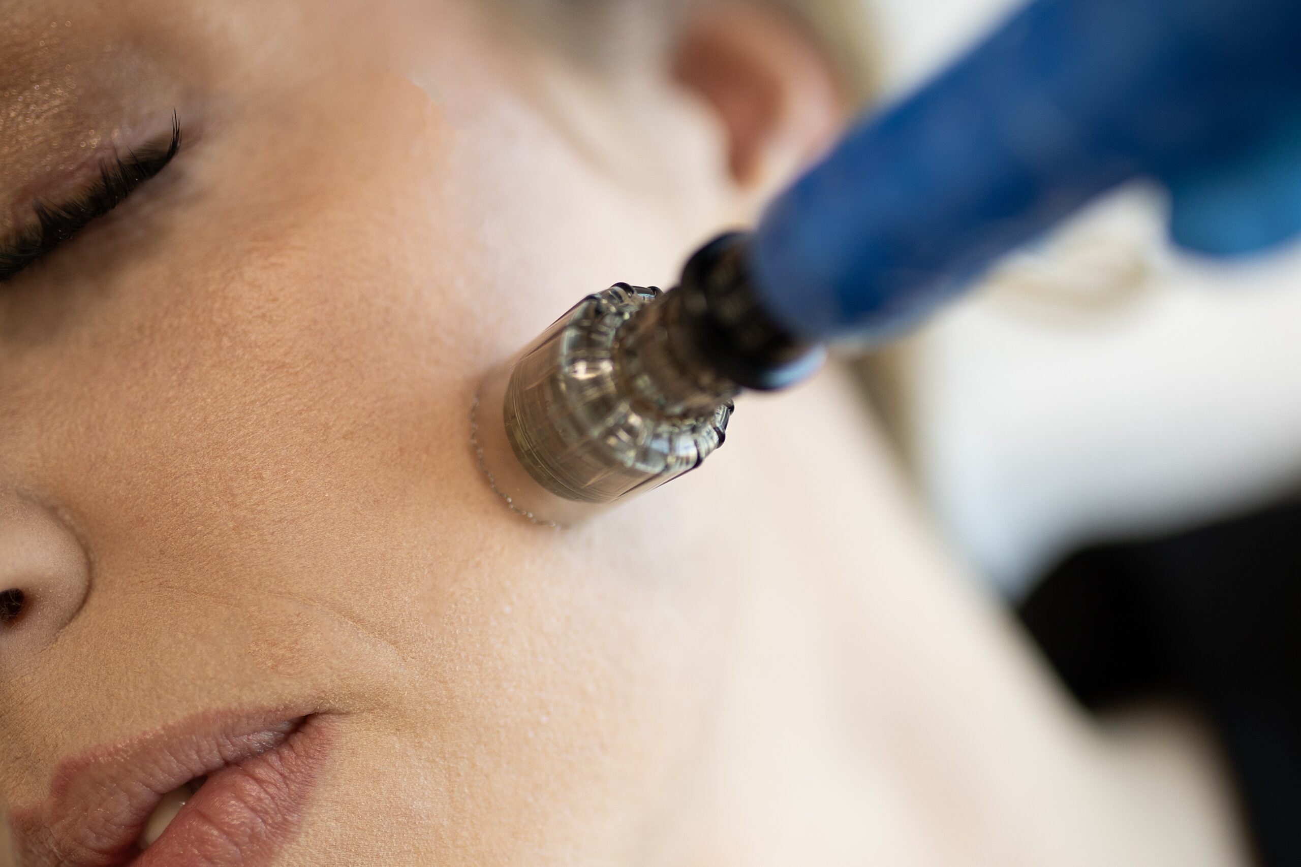 DCCC microneedling on face